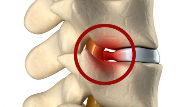 Brjósklos Brjósklos